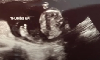 An 18-week-old unborn baby gives a thumbs-up during an ultrasound