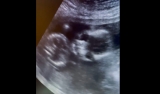 Houston Pregnancy Help Center provided ultrasounds to migrant girls housed at a facility there