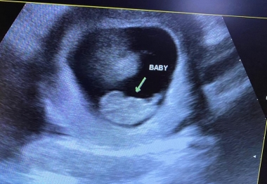 Heartbeat of Miami client Jashley&#039;s ultrasound