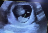 Heartbeat of Miami client Jashley's ultrasound
