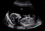 Baby Zion's 20-week ultrasound
