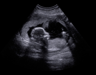 Federal appeals court rules Tennessee can ban abortions on babies with Down syndrome