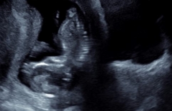 &quot;Deanna&#039;s&quot; ultrasound